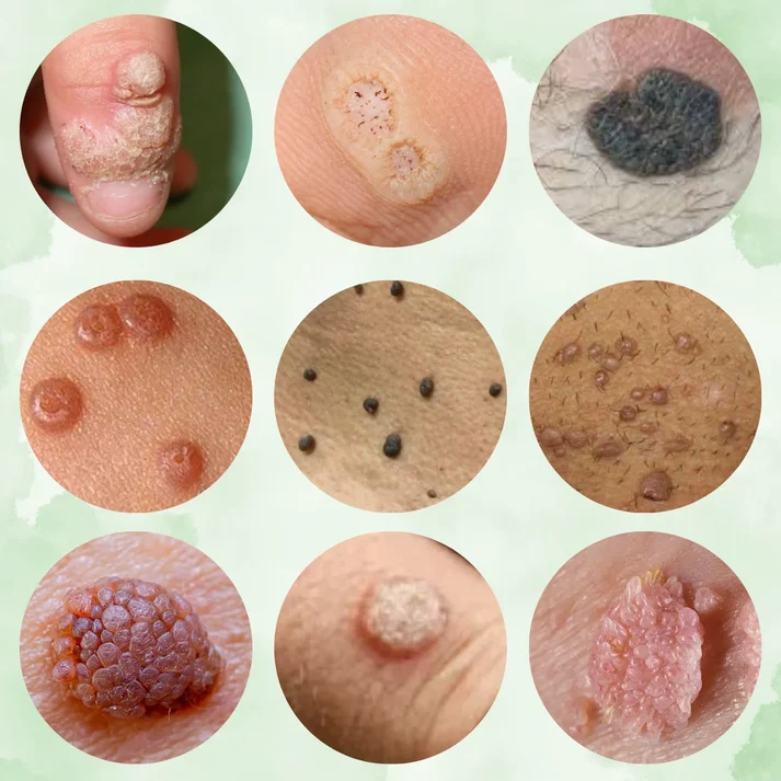 AdFire™ Eliminador Total de Verrugas e Imperfecciones medicado