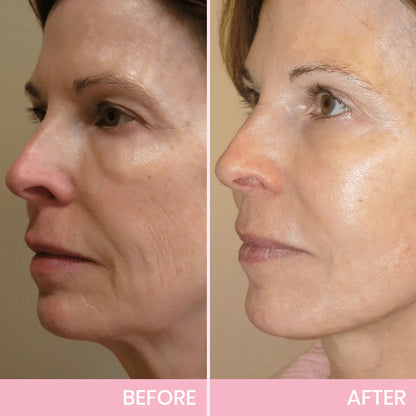 La Cinta Adhesiva Invisible LBMLBM™ V-Face Lifting-