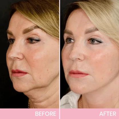 La Cinta Adhesiva Invisible LBMLBM™ V-Face Lifting-