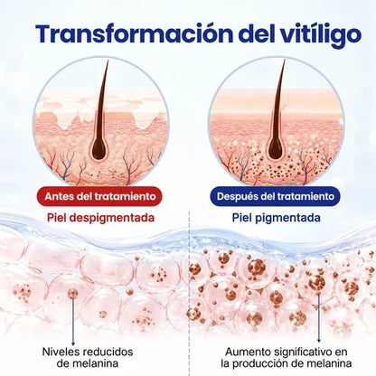 VitiRepair - Spray avanzado para el vitiligo y parches blancos