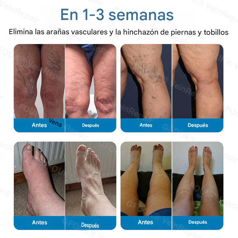 FOUK® Parche de microagujas para la reparación de venas