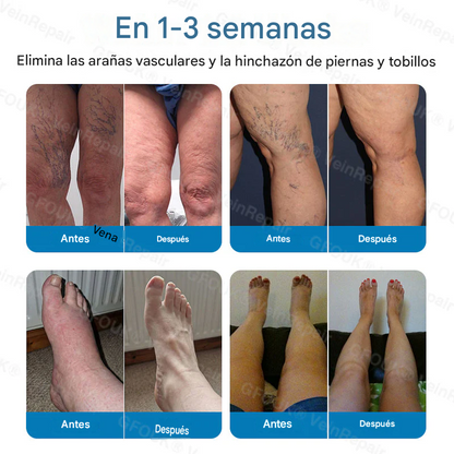 FOUK® Parche de microagujas para la reparación de venas