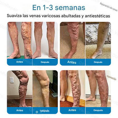 FOUK® Parche de microagujas para la reparación de venas