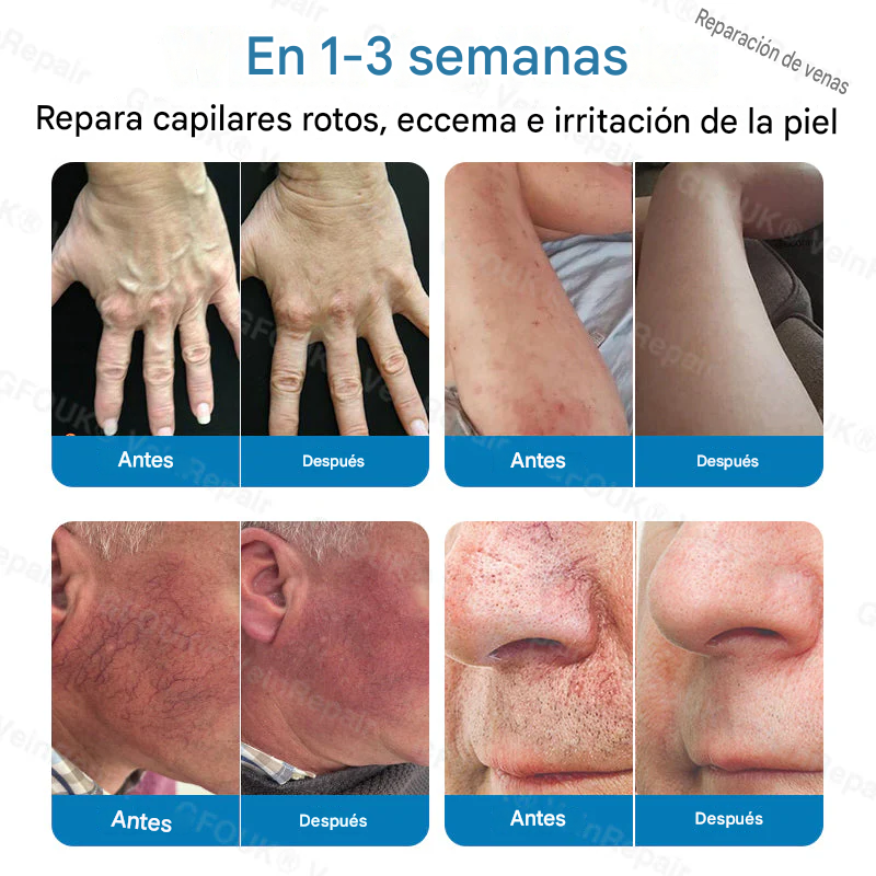 FOUK® Parche de microagujas para la reparación de venas