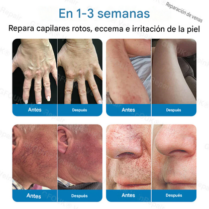 FOUK® Parche de microagujas para la reparación de venas